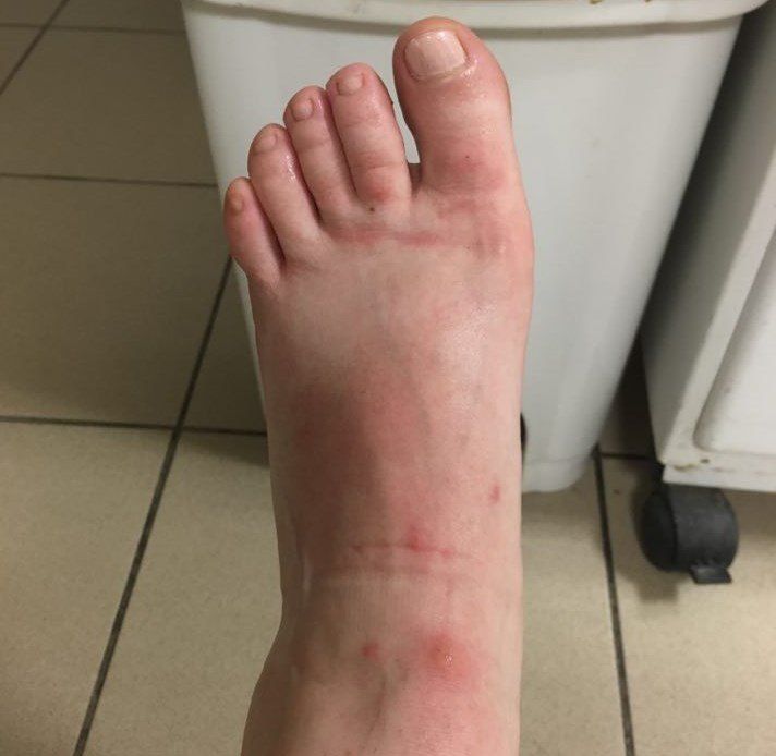 Szúnyogcsípések allergiás reakcióval